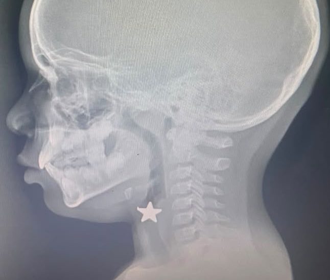 Hospital pediátrico salva a niño que aspiró un objeto metálico y alerta sobre riesgos en la infancia