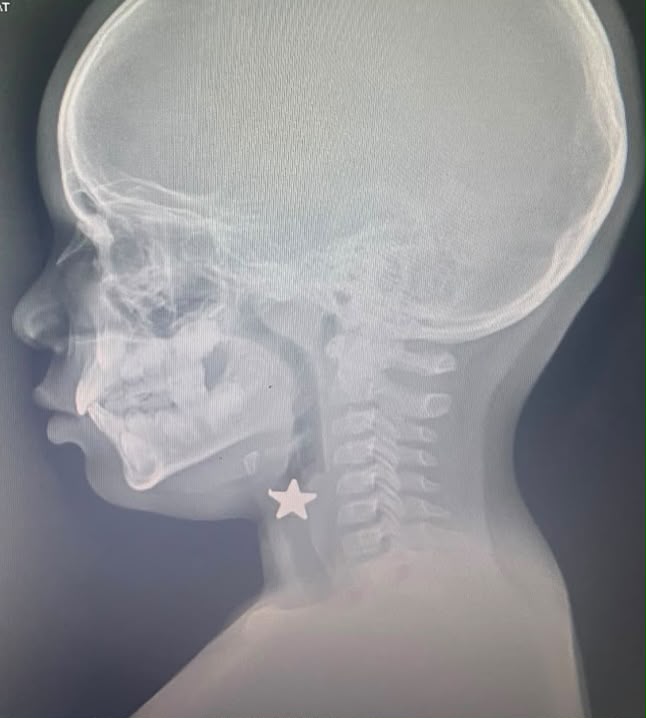 Hospital pediátrico salva a niño que aspiró un objeto metálico y alerta sobre riesgos en la infancia